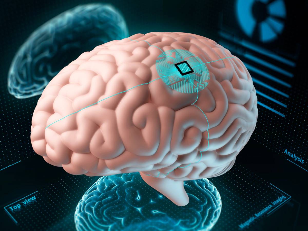 Implantan Chip Cerebral En Un Ser Humano Códigotv