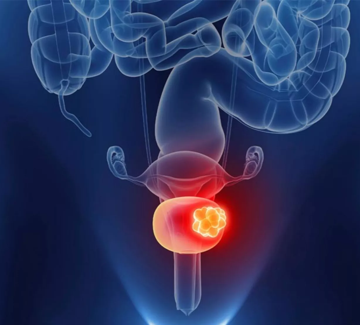 Por qué los hombres y fumadores tienen mayor riesgo de sufrir cáncer de ...